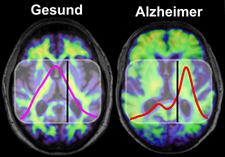 Determination of the amyloid-ß secondary structure distribution in blood plasma by an immuno-IR-sensor correlates with PET scanning and CSF markers in Alzheimer's disease (AD) patients, with potentials to be an accurate, simple, and minimally invasive biomarker for early AD detection. © LS Biophysik