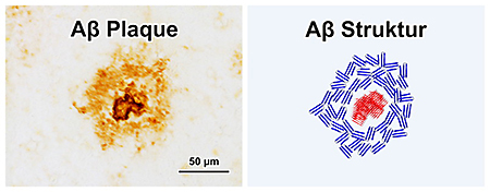 Links ist ein voll entwickelter Plaque aus braun angefärbtem Aß zu sehen. Rechts ist die durch Infrarot-Mikroskopie ermittelte Struktur des Aß gezeigt. In Kern befinden sich Fibrillen (rot), darum liegen hauptsächlich Oligomere (blau). © Prodi